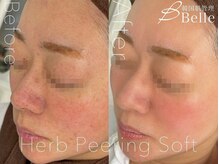 ベル 高槻店(Belle)/ハーブピーリング｜ニキビケア
