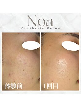 ノア 新宿(Noa)/ハーブピーリング+マシン1回