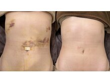 リム ビューティー(RYM BEAUTY)/インディバボディ