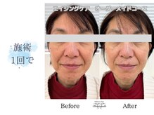 ディアスマイル(Dear.smile)/施術1回で