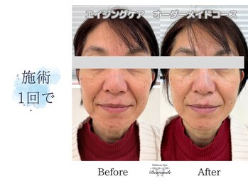 ディアスマイル(Dear.smile)/施術1回で