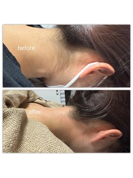 【光脱毛/WAX脱毛】doucek beauty/うなじワックス+光脱毛