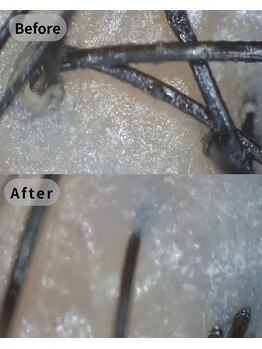 ストリクス(STRIX)/Before/After 【ヘッドスパ】