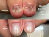 【噛み爪/むしり爪/超深爪】まずは気軽にご相談♪カウンセリング 30分