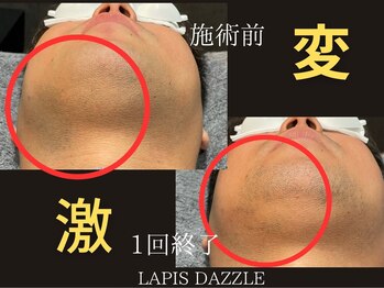 ラピスダズル(LAPIS DAZZLE)/ヒゲ脱毛☆途中経過(1回終了後)