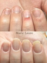 マリーロール 淀屋橋本店(Marie Laure)/自爪育成/深爪矯正/ネイルケア