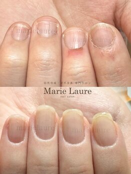 マリーロール 淀屋橋本店(Marie Laure)/自爪育成/深爪矯正/ネイルケア