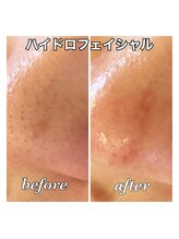 サンクレール(3.ClaiR)/ハイドロフェイシャル