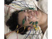 インフィニティ 名古屋金山(INFINITY)/美容鍼　電気鍼でリフトアップ