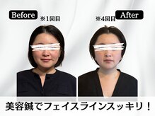 ハリユナイテッド 原宿鍼灸 整体院(HALI UNITED)/美容鍼でフェイスラインスッキリ
