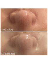 ブリエ(Briller)/鼻の黒ずみ・ブラックヘッド