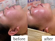 ウィズルーチェ つくばみどりの店(with luce)/二重顎たるみの緩和にV字小顔