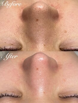 アカヌケ(AKANUKE)/黒ずみ毛穴ケアでニキビ改善