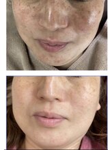 ココ 梅田中津(COCO.)/シミしわ改善＊ハーブピーリング