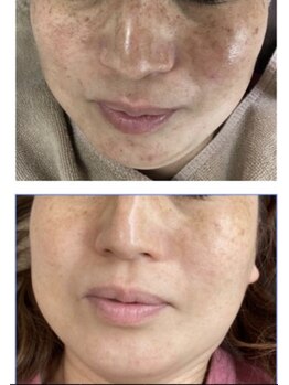 ココ 梅田中津(COCO.)/シミしわ改善＊ハーブピーリング