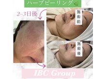 トータルサロンアイビーシー(トータルサロンIBC)/ハーブピーリングで神肌へ☆