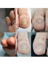 ドクターネイル爪革命 長野店/【肥厚・変形爪】ネイル/フット