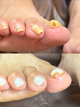 ネイルズ バイ ユイ 外苑前(Nails by Yui)/巻き爪ケアジェル