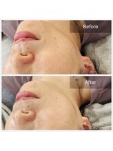 シエロ(Cielo)/ハーブピーリングNMN効果◎