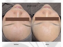 アン ビューティー(ann beauty)/施術1回【症例写真】