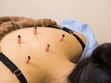 いなほ はりきゅう整骨院 東新宿/鍼灸(吸い玉併用)コース