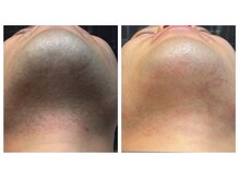 メイクォーク(MAY QUARK)/ひげ脱毛