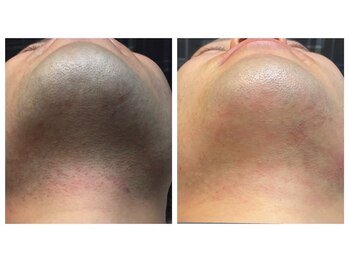 メイクォーク(MAY QUARK)/ひげ脱毛