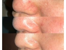 ル シーニュ/毛穴エクストラクション