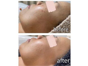 コンフィデンスサロン(Confidence Salon)/【症例】艶肌、ニキビケア