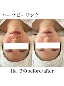 イム(I'm.)/ハーブピーリングbefore/after