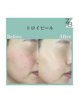 ザラハビューティー(ZARAHA Beauty)/トロイピール