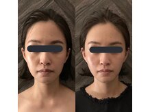 ハイコガオ(HIKOGAO)/小顔矯正40分