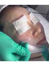 スア(SUA)/3D水光ピーリング