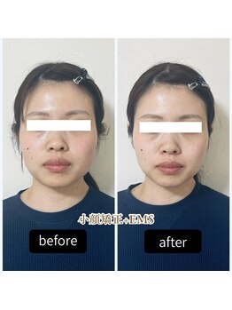ミニン(minin)/小顔矯正+EMS