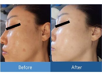 ローズドゥシャロン(Rose de CHALON)/透明感アップ&シミ改善♪