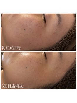 ブリエ(Briller)/毛穴の開き・むくみ改善