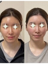 小顔22 ボルティ 本店(Bolty)/顔の心臓部【中顔面を整える】