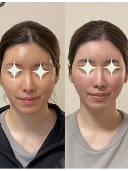 小顔22 ボルティ 本店(Bolty)/顔の心臓部【中顔面を整える】