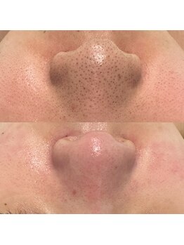 ミューズ(MUSE)/エクストラクション＋白玉ピコ