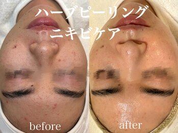 ネオリー(neorii)/ハーブピーリング　肌改善