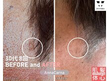 アンナカルナ(AnnaCarna)/男性もシミは気になりますよね