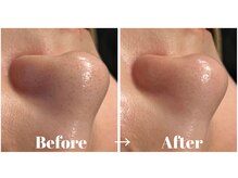 カラーリリー アンド ユン(Calla lily & yun)/ハイドラ毛穴洗浄の効果♪