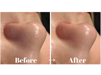 カラーリリー アンド ユン(Calla lily & yun)/ハイドラ毛穴洗浄の効果♪