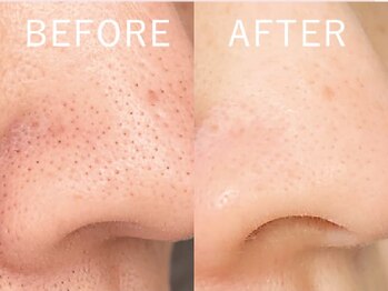 ビューティーリバース 大船店/ハイドロスプラッシュ