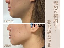 エイプリルの雰囲気（理想の輪郭・横顔に♪二重顎/たるみ/目周りのシワ/首のシワ◎）