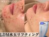 【顎ニキビや深い悩みに】水玉リフティングLDM24 +導入美容　25,000→14,800