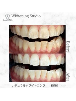 ラクナ(RAKUNA)/美容ホワイトニング初回体験