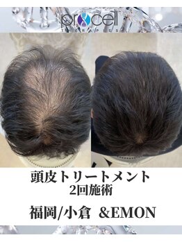 アンドエモン(&EMON)/【頭皮】プロセル効果