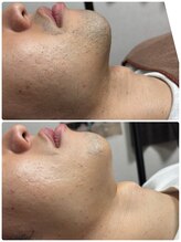 シック 南風原店(Chic)/20代　５ヶ月後の経過写真