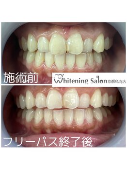 ホワイトニングサロン 京都烏丸店/ホワイトニング施術例